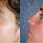 Rhinoplasty