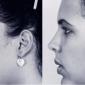 Rhinoplasty, Chin Enhancement