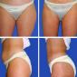 Tummy Tuck and Breast Lift