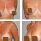 Breast Lift, before and after breast lift without augmentation