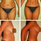 Tummy Tuck and Breast Lift Picture