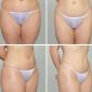 Extreme liposuction on stomach, hips and inner thighs