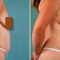 Tummy tuck with  breast lift and augmentation