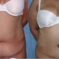 Tummy Tuck and Mini Tummy Tuck