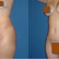 Tummy Tuck can change your tummy shape in a few hours