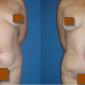 Tummy Tucks flatten your stomach and remove your extra skin