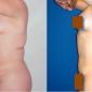 Tummy Tuck, with breast lift