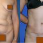 Tummy Tuck and Mini Tummy Tuck